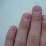 Пустота под ногтем: причины появления и способы её лечения Удаление гноя из под ногтя