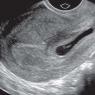 Fertilized egg 2.8 mm, what is the period.  When an ultrasound shows signs of pregnancy