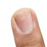 White spots on fingernails: causes and treatment