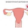 How to remove an ectopic pregnancy in the early stages